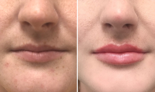 dry lips treatment before after mississauga oakville